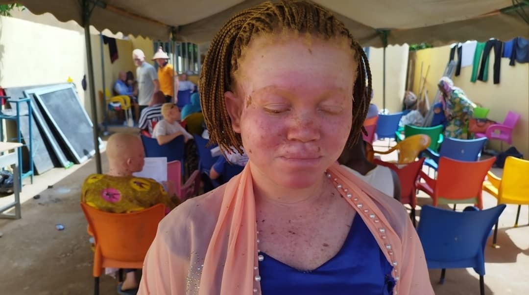 Albi week albinos